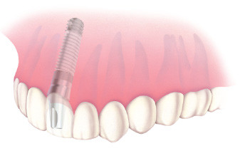 Implanty - odbudowa pojedynczego zęba