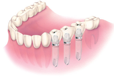 Implanty - odbudowa kilku zębów