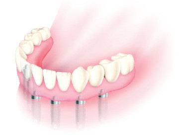 Implanty - odbudowa wszystkich zębów