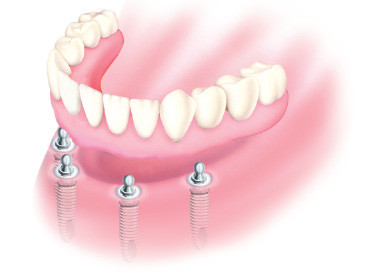 Ruchoma proteza na implantach