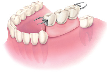 Proteza dentystyczna częściowa ruchoma
